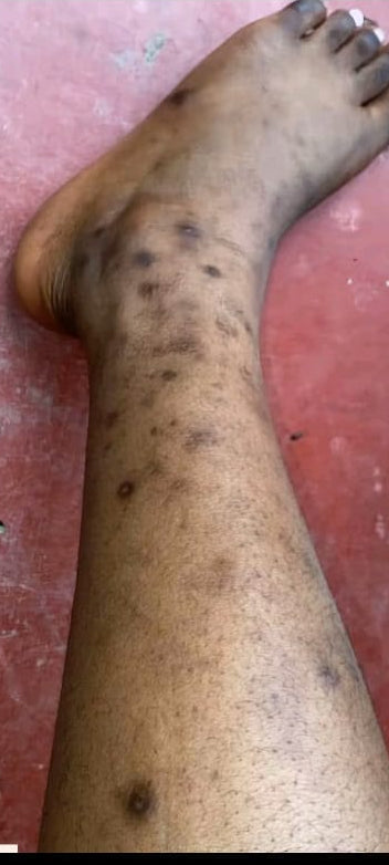 MOHET Sérum Éclat Pieds – Anti Quinto & Correcteur de Taches Noires