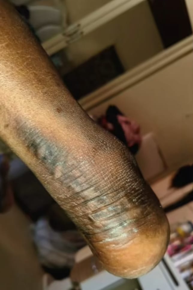 MOHET Sérum Éclat Pieds – Anti Quinto & Correcteur de Taches Noires