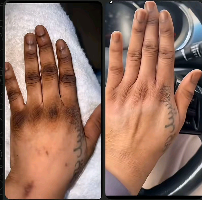 MOHET Sérum Éclat Pieds – Anti Quinto & Correcteur de Taches Noires